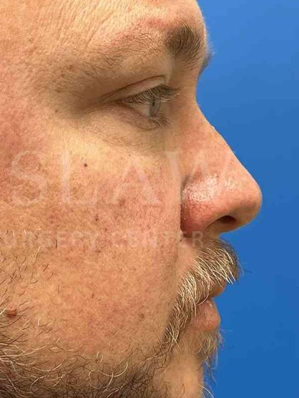 Rhinoplasty Before & After Patient #1127