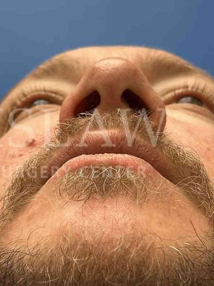 Rhinoplasty Before & After Patient #1127