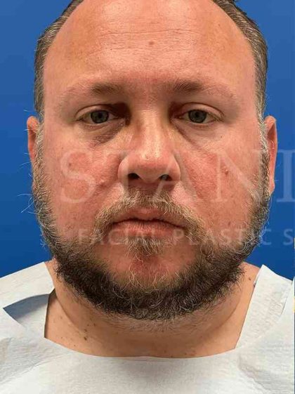 Rhinoplasty Before & After Patient #1127
