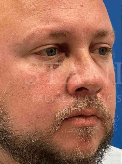 Rhinoplasty Before & After Patient #1127