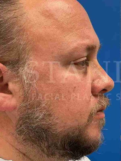 Rhinoplasty Before & After Patient #1127