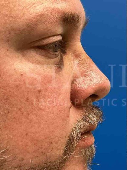 Rhinoplasty Before & After Patient #1127