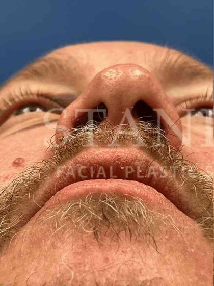 Rhinoplasty Before & After Patient #1127