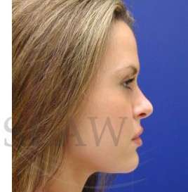 Rhinoplasty Before & After Patient #1296