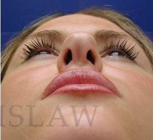 Rhinoplasty Before & After Patient #1296