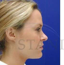Rhinoplasty Before & After Patient #1296