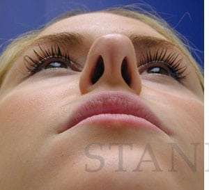 Rhinoplasty Before & After Patient #1296