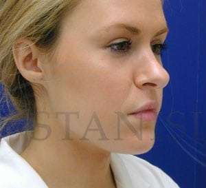 Rhinoplasty Before & After Patient #1296
