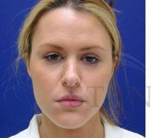 Rhinoplasty Before & After Patient #1296