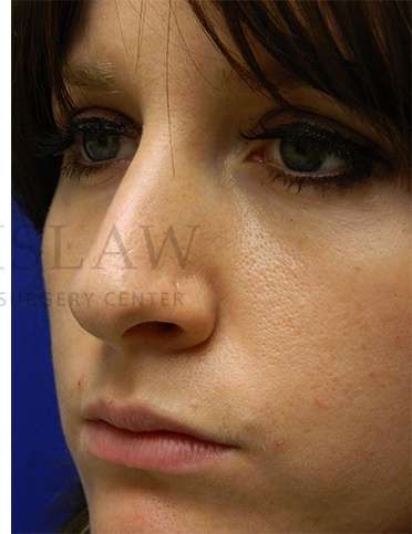 Rhinoplasty Before & After Patient #1181