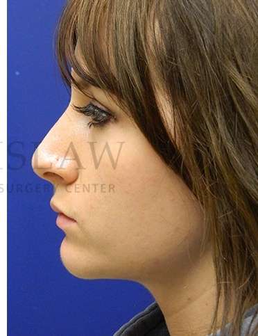 Rhinoplasty Before & After Patient #1181