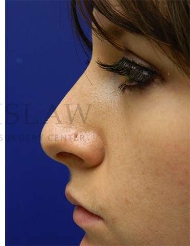 Rhinoplasty Before & After Patient #1181