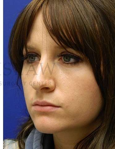 Rhinoplasty Before & After Patient #1181