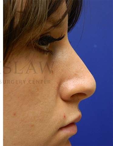 Rhinoplasty Before & After Patient #1181