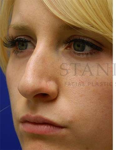 Rhinoplasty Before & After Patient #1181