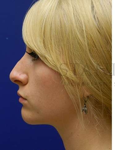 Rhinoplasty Before & After Patient #1181