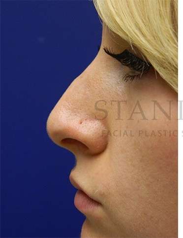 Rhinoplasty Before & After Patient #1181