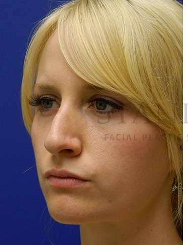 Rhinoplasty Before & After Patient #1181