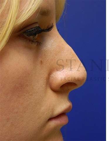 Rhinoplasty Before & After Patient #1181