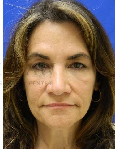 Rhinoplasty Before & After Patient #1287