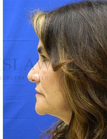 Rhinoplasty Before & After Patient #1287
