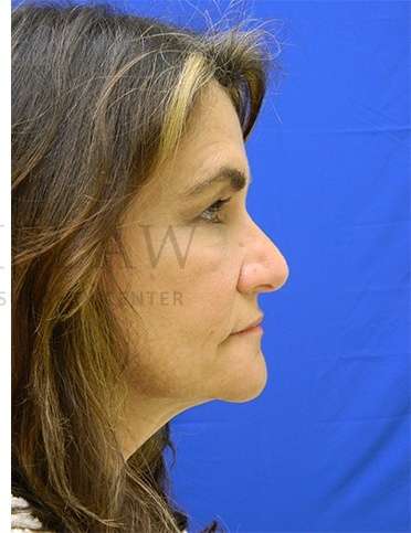 Rhinoplasty Before & After Patient #1287