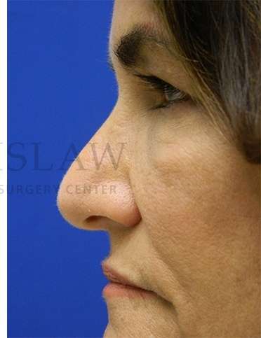 Rhinoplasty Before & After Patient #1287