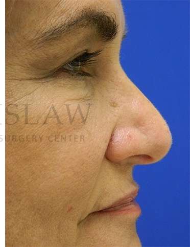 Rhinoplasty Before & After Patient #1287