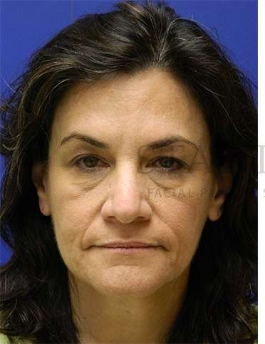 Rhinoplasty Before & After Patient #1287