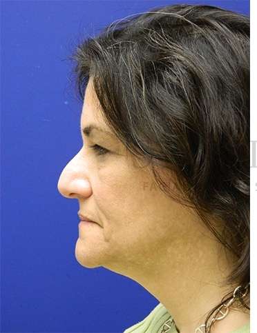 Rhinoplasty Before & After Patient #1287