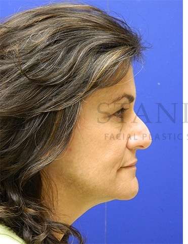 Rhinoplasty Before & After Patient #1287