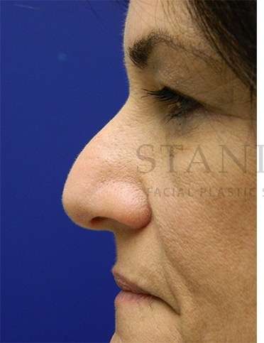 Rhinoplasty Before & After Patient #1287