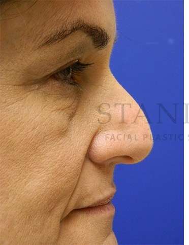 Rhinoplasty Before & After Patient #1287