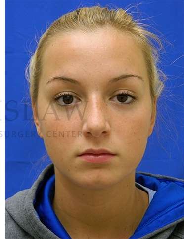 Rhinoplasty Before & After Patient #1276