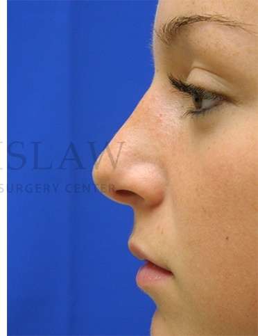 Rhinoplasty Before & After Patient #1276