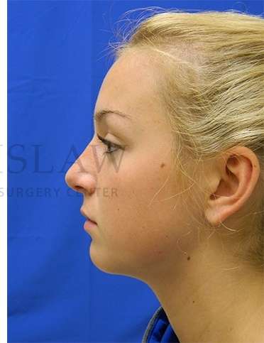 Rhinoplasty Before & After Patient #1276