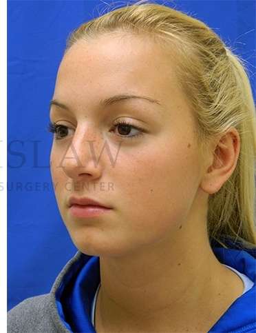 Rhinoplasty Before & After Patient #1276