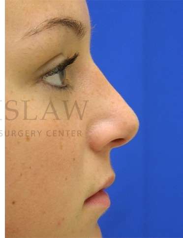 Rhinoplasty Before & After Patient #1276