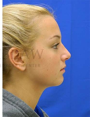 Rhinoplasty Before & After Patient #1276