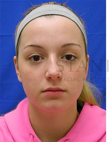 Rhinoplasty Before & After Patient #1276