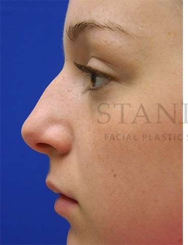 Rhinoplasty Before & After Patient #1276