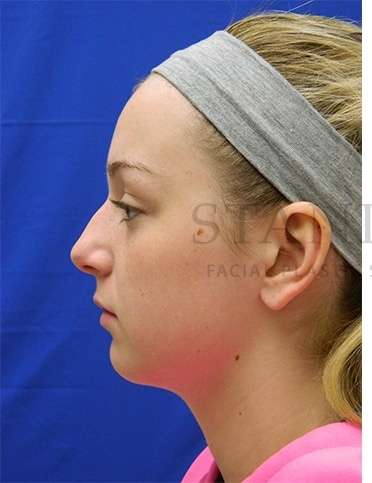 Rhinoplasty Before & After Patient #1276
