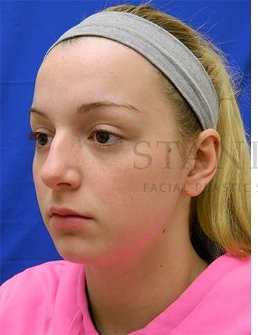 Rhinoplasty Before & After Patient #1276