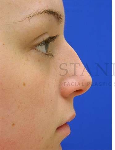 Rhinoplasty Before & After Patient #1276