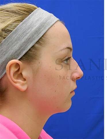 Rhinoplasty Before & After Patient #1276