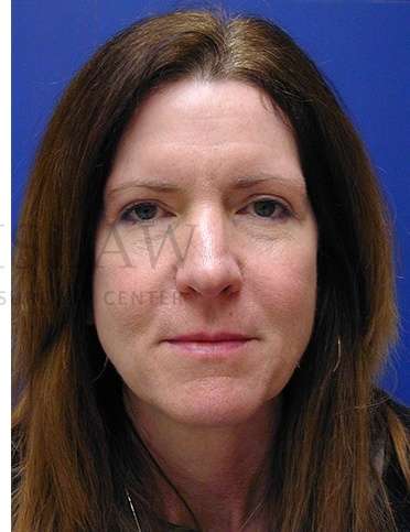 Rhinoplasty Before & After Patient #1263