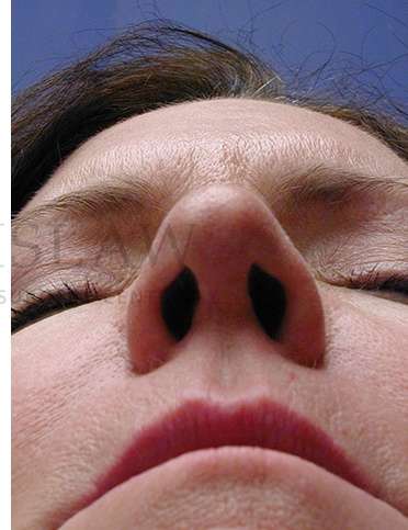 Rhinoplasty Before & After Patient #1263