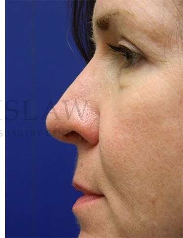 Rhinoplasty Before & After Patient #1263
