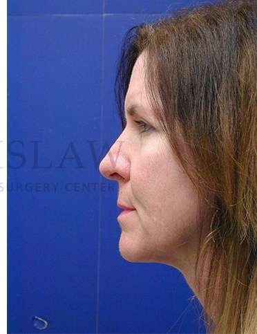 Rhinoplasty Before & After Patient #1263