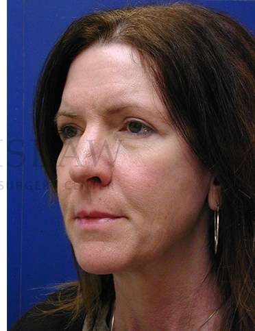 Rhinoplasty Before & After Patient #1263
